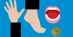 Ilustrasi campak / penyakit menular / virus. (Sumber: Pixabay | Foto: Mohamed_hassan)