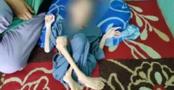 Bocah berusia 10 tahun warga asal Desa Banyumas, Kecamatan Bojong, Pandeglang, hanya berbaring di tempat tidur karena menderita gizi buruk dan kelumpuhan. (Sumber: Istimewa)