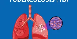 Ilustrasi Tuberkulosis atau TBC. (Sumber: Kemkes.go.id)