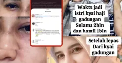 Suila Rohill membagikan foto kondisi lebam usai dugaan kekerasan, memicu simpati dan kemarahan netizen. Nama Ustadz Zaky Mubarok ikut terseret sebagai mantan suami dan terduga pelaku. (Sumber: Instagram/@suilarohill)