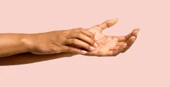 Ilustrasi, penyebab dan cara mengatasi eksim. (Sumber: Istimewa)