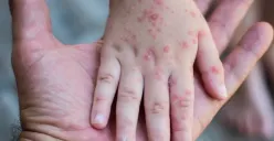 Ilustrasi campak-rubella. (Sumber: Alodokter)