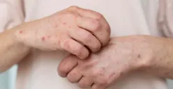 Ilustrasi, Kemenkes imbau masyarakat waspada penularan campak. (Sumber: freepik)