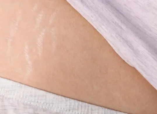 Beberapa penyebab stretch marks (Sumber: Freepik)