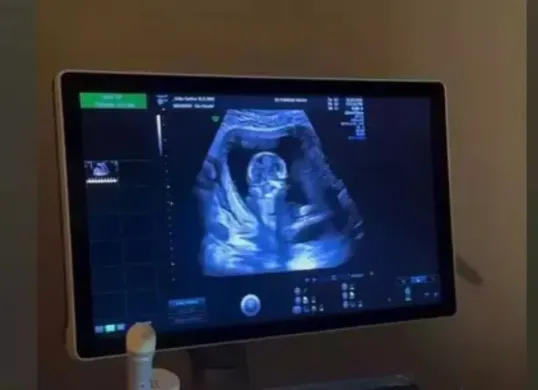 Erika Carlina pastikan kehamilannya bukan settingan, ungkap bukti USG. (Sumber: Instagram)