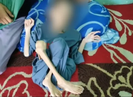 Bocah berusia 10 tahun warga asal Desa Banyumas, Kecamatan Bojong, Pandeglang, hanya berbaring di tempat tidur karena menderita gizi buruk dan kelumpuhan. (Sumber: Istimewa)