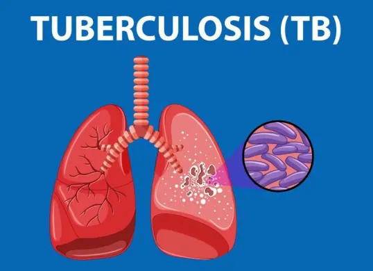 Ilustrasi Tuberkulosis atau TBC. (Sumber: Kemkes.go.id)