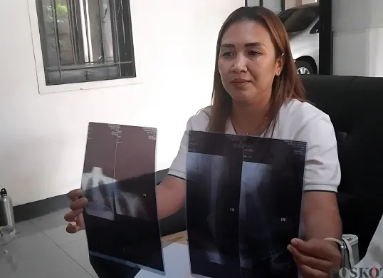 Amelia menunjukkan hasil rontgen anaknya yang mengalami pergeseran tulang akibat dirundung teman sekelasnya. (Sumber: POSKOTA | Foto: Nurpini Aulia Rapika)