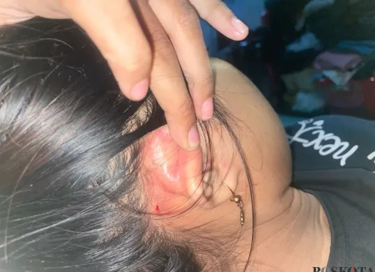 HK mengalami luka di beberapa bagian tubuhnya yang disebabkan oleh IAP. Ia tidak terima jika ditetapkan sebagai tersangka dan mengaku tak kuat membayar uang damai. (Sumber: Poskota/Nurpini Aulia Rapika)