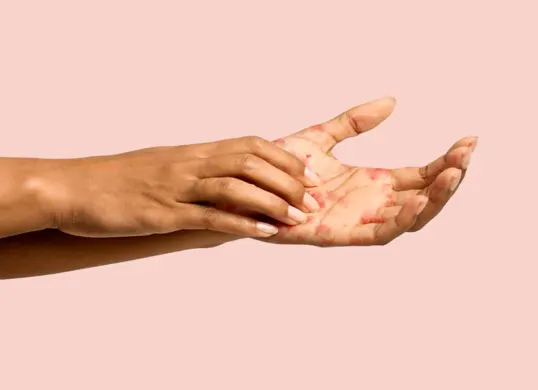 Ilustrasi, penyebab dan cara mengatasi eksim. (Sumber: Istimewa)