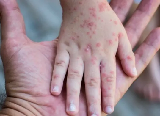 Ilustrasi campak-rubella. (Sumber: Alodokter)