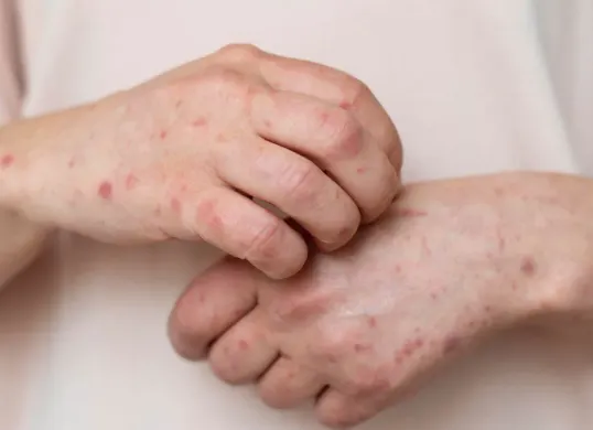 Ilustrasi, Kemenkes imbau masyarakat waspada penularan campak. (Sumber: freepik)