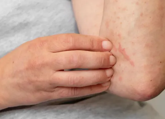 Ilustrasi, Epidemiolog imbau orang tua waspada gejala campak pada anak. (Sumber: freepik)