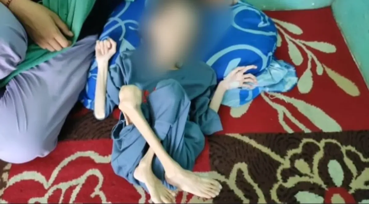 Bocah berusia 10 tahun warga asal Desa Banyumas, Kecamatan Bojong, Pandeglang, hanya berbaring di tempat tidur karena menderita gizi buruk dan kelumpuhan. (Sumber: Istimewa)
