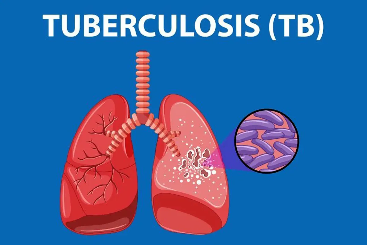 Ilustrasi Tuberkulosis atau TBC. (Sumber: Kemkes.go.id)