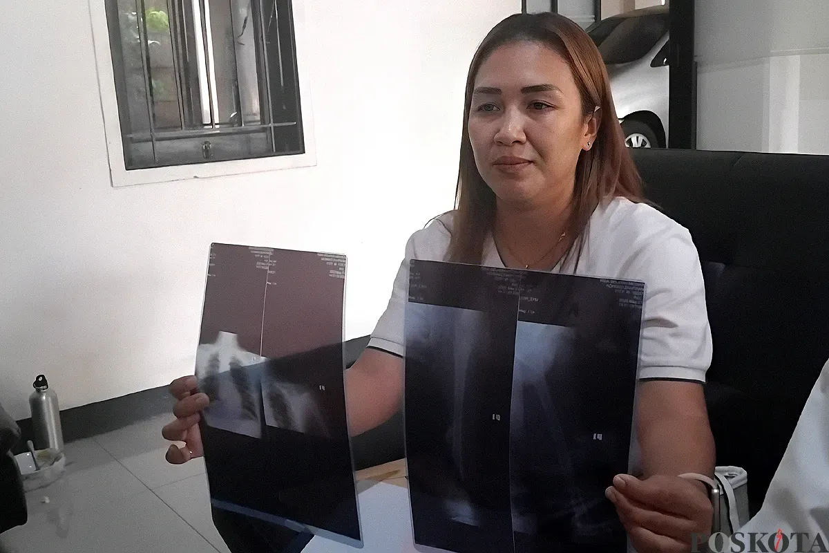 Amelia menunjukkan hasil rontgen anaknya yang mengalami pergeseran tulang akibat dirundung teman sekelasnya. (Sumber: POSKOTA | Foto: Nurpini Aulia Rapika)