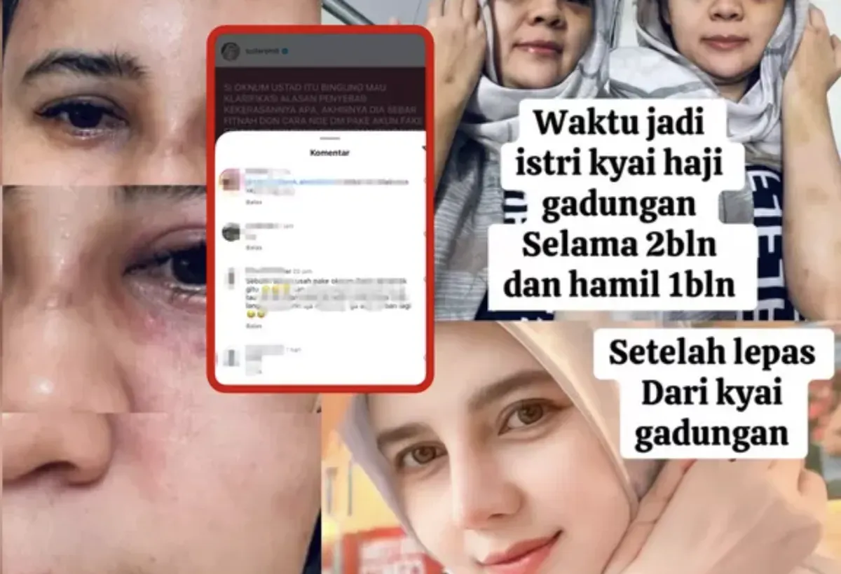 Suila Rohill membagikan foto kondisi lebam usai dugaan kekerasan, memicu simpati dan kemarahan netizen. Nama Ustadz Zaky Mubarok ikut terseret sebagai mantan suami dan terduga pelaku. (Sumber: Instagram/@suilarohill)