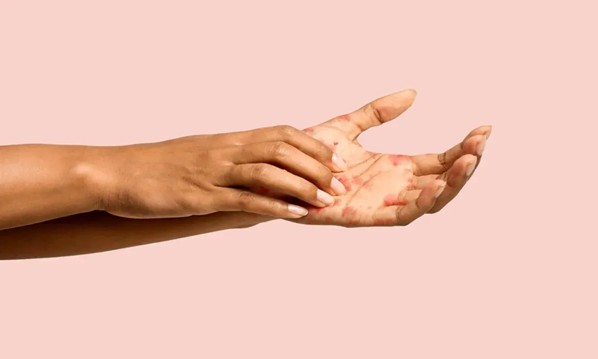 Ilustrasi, penyebab dan cara mengatasi eksim. (Sumber: Istimewa)