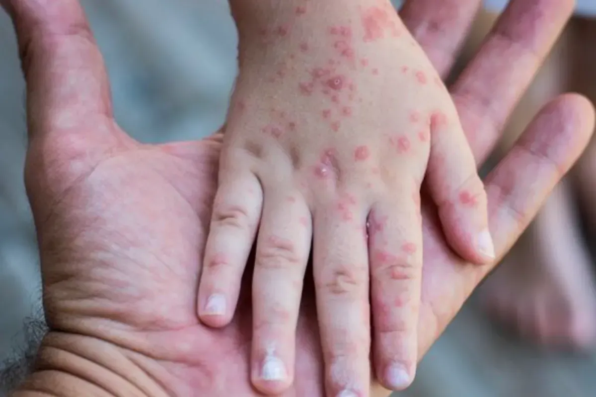 Ilustrasi campak-rubella. (Sumber: Alodokter)