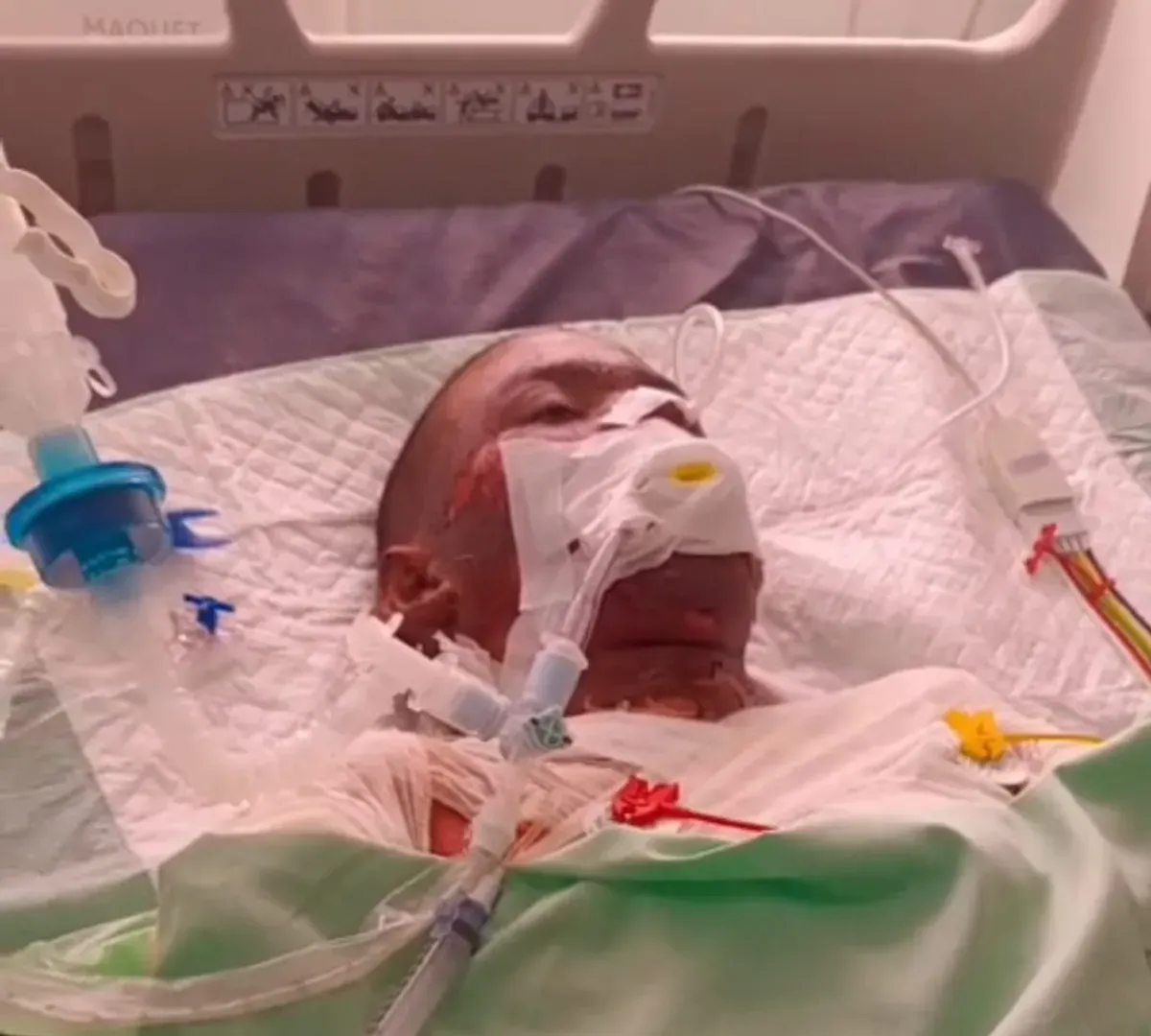 Ilustrasi - Korban ledakan menjalani perawatan di rumah sakit. (Sumber: Istimewa)