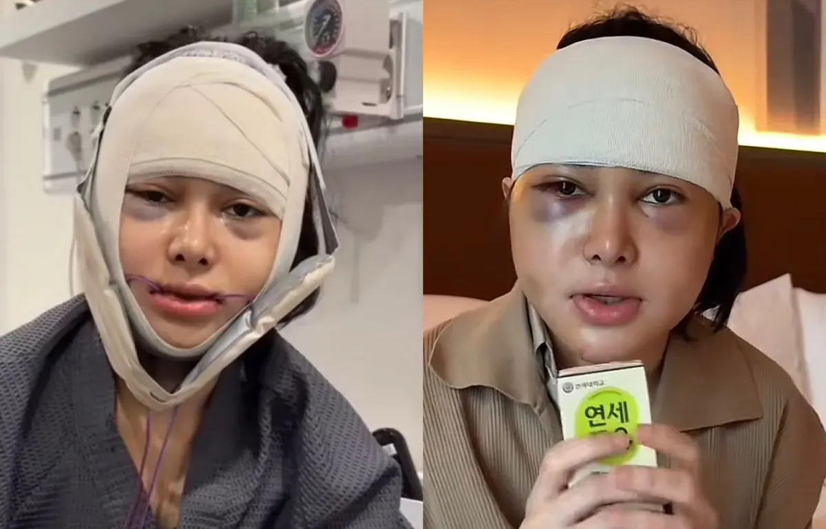 Dilan Janiyar lakukan operasi muka di Korea, respon netizen kecewa. (Sumber: TikTok : @dilanjaniyar.)