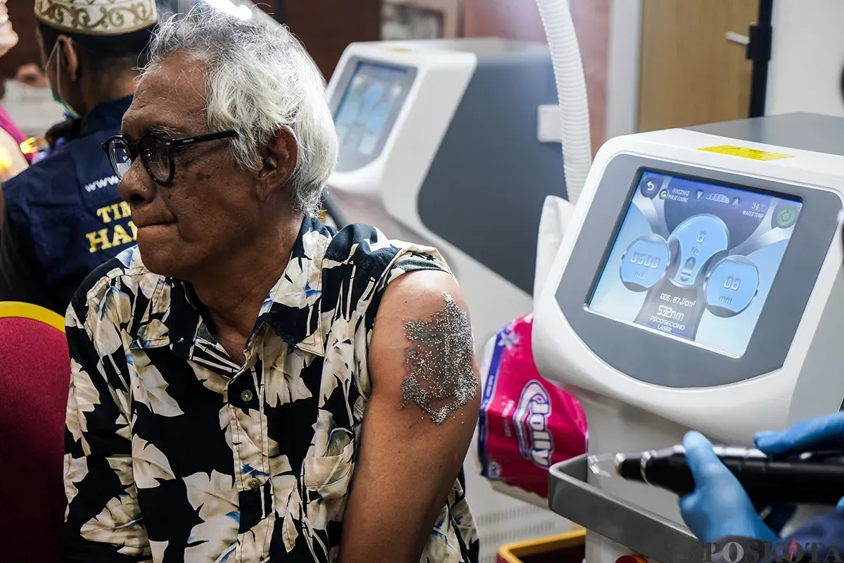 Petugas menghapus tato peserta menggunakan laser di Balai Kota DKI Jakarta, Senin, 10 Maret 2025. (Sumber: Poskota/Bilal Nugraha Ginanjar)