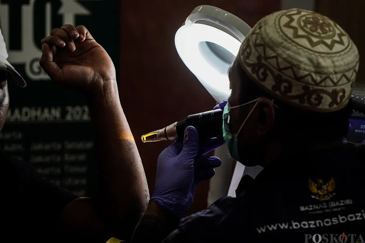 Petugas menghapus tato peserta menggunakan laser di Balai Kota DKI Jakarta, Senin, 10 Maret 2025. (Sumber: Poskota/Bilal Nugraha Ginanjar)
