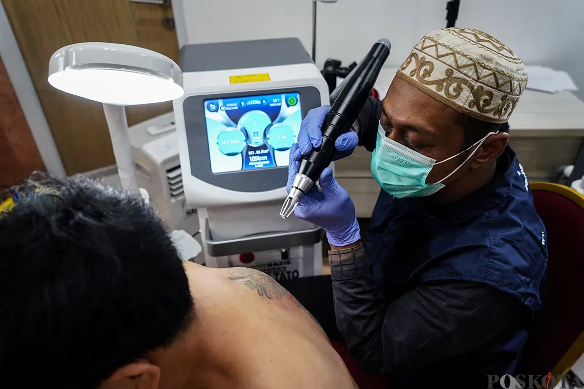 Petugas menghapus tato peserta menggunakan laser di Balai Kota DKI Jakarta, Senin, 10 Maret 2025. (Sumber: Poskota/Bilal Nugraha Ginanjar)