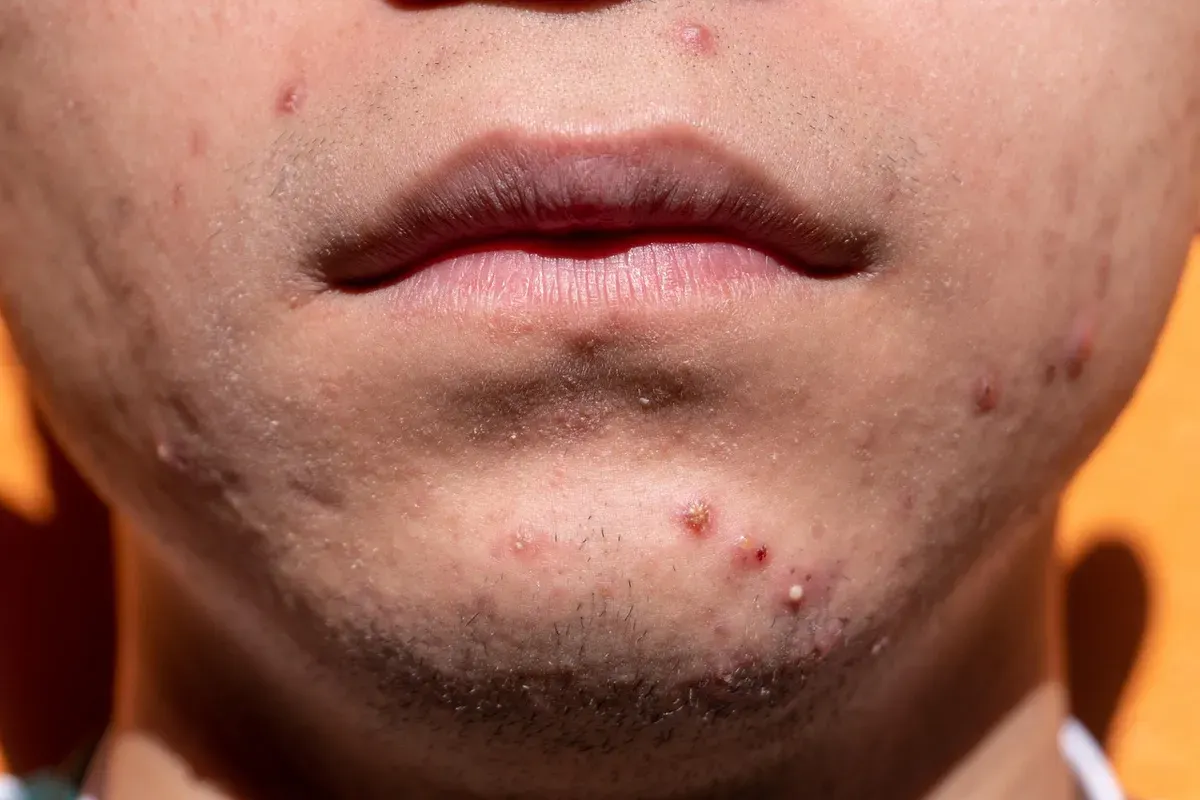 Cara membuat masker alami untuk menghilangkan bekas jerawat dan komedo. (Sumber: Pixabay/yiyiphotos)