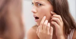 Simak cara efektif menghilangkan jerawat batu dengan mudah di rumah. (Sumber: Pinterest/StyleCaster)