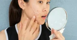 Hempaskan Jerawat Melalui Cara Mudah Ini, Murah dan Tanpa Biaya Mahal, Simak Caranya!. (Sumber: Pinterest/ObatJerawatPalingAmpuh.com)
