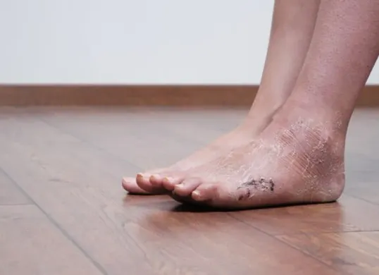 Beberapa cara mengatasi kaki pecah-pecah (Sumber: Freepik)