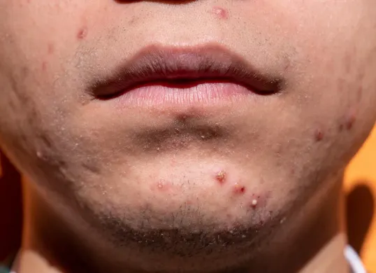 Cara membuat masker alami untuk menghilangkan bekas jerawat dan komedo. (Sumber: Pixabay/yiyiphotos)